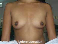 plastic-surgery-breast-augmentation 